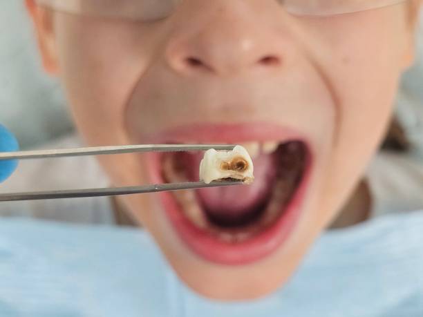 Best Emergency Dentist for Knocked-Out Tooth in El Paso, IL
